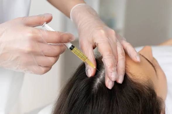 تزریق PRP در پوست سر